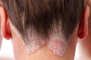 hair-psoriasis